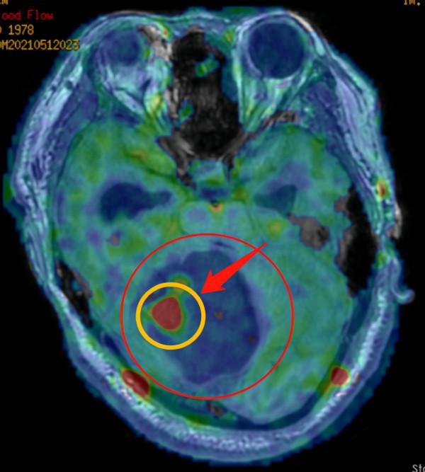 中年男子走路像醉漢，檢查發現腦內生出“戒指”