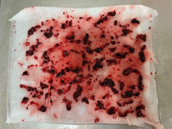 血栓清除率超90％，取出亞急性血栓，樂奧醫療靜脈取栓導管新突破