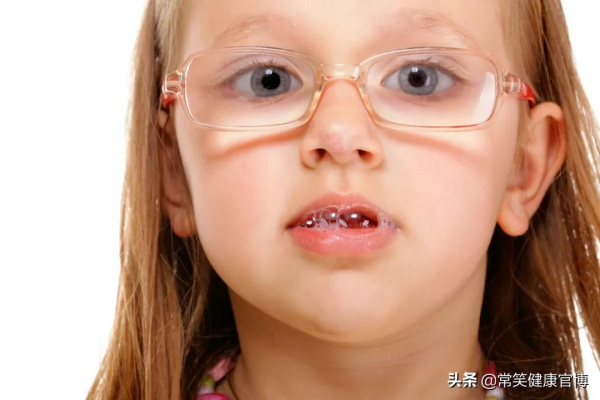 能消毒、能殺菌、能止癢?“口水”這麼能幹嗎? 能消毒、能殺菌、能止癢?“口水”這麼能幹嗎?