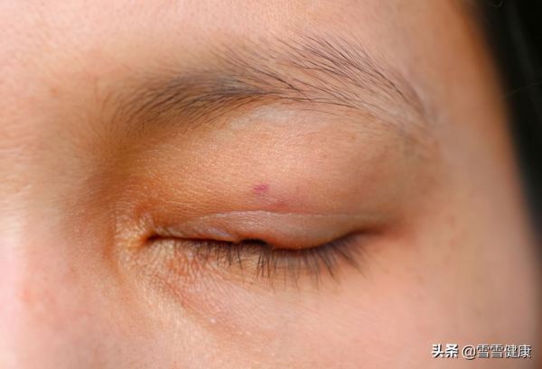 左眼皮跳財，右眼皮跳災？眼皮亂跳，可能與這4個因素有關