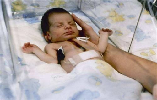 1984年,美國一女嬰移植狒狒心臟手術成功,女孩最後能不能活下去 1984年,美國一女嬰移植狒狒心臟手術成功,女孩最後能不能活下去