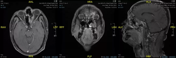 南昌大學二附院耳鼻咽喉頭頸外科成功診治鼻腔鼻竇轉移性腎透明細胞癌患者