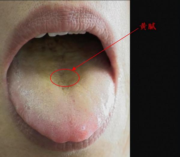 溼熱、寒溼、痰溼：病因不同、症狀不同、調理方法也不同
