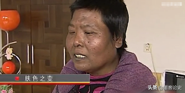 真實故事:山西45歲女子一夜變黑,體重急速增加,手術後讓家人落淚