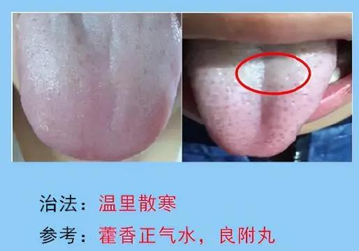 脾胃病的常見舌苔分析，脾胃不好的人要多多瞭解，你是圖幾？