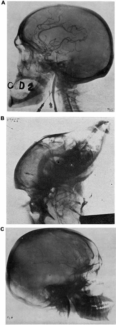 30萬人永無休止的噩夢!1949年的醫學獎:諾貝爾獎史上最大恥辱 30萬人永無休止的噩夢!1949年的醫學獎:諾貝爾獎史上最大恥辱
