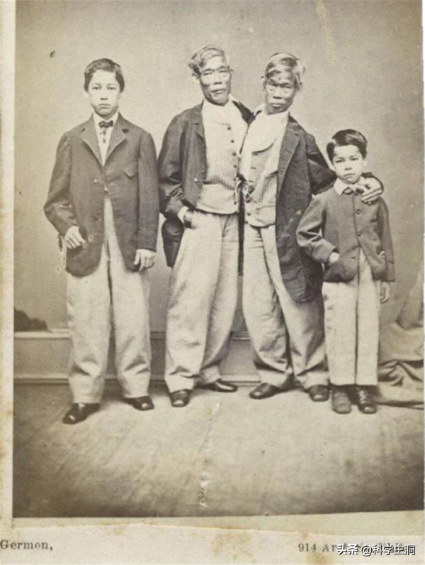 連體人一個去世怎麼辦？連體姐姐死後，妹妹被迫和遺骸生存2天