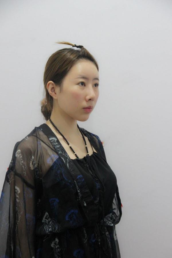 32歲寶媽自體脂肪填充50天，親戚以為我悄悄地換了一張臉