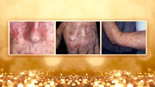 身上長出小疙瘩、紅斑，不痛不癢就沒事？警惕是惡性腫瘤潛伏體內