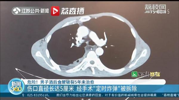 危險！男子酒後食管破裂5年未治癒 猶如“定時炸彈”