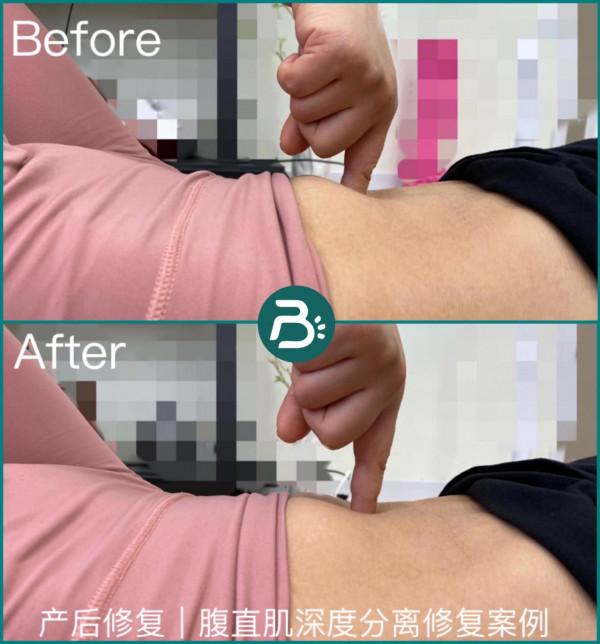 產後肚子如何恢復如初?專家:產後需要從裡到外逐層修復腹部 產後肚子如何恢復如初?專家:產後需要從裡到外逐層修復腹部