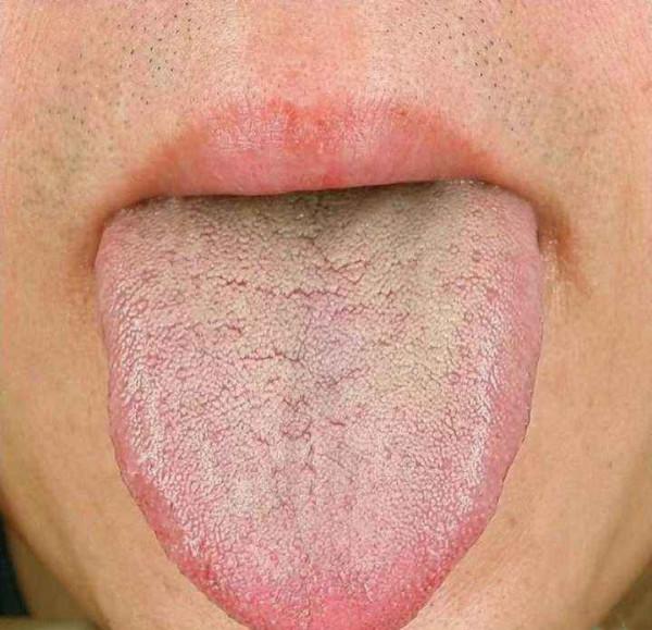 中醫論治糖尿病，不同證型的糖尿病該如何治療？快看看你是哪一種