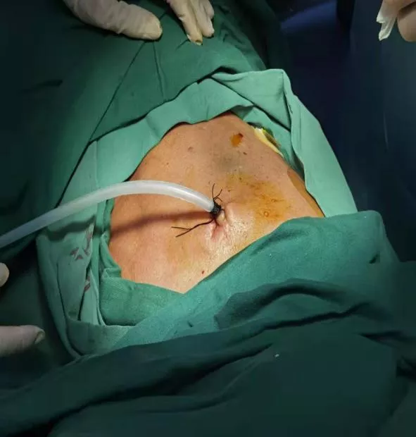 無痛內科胸腔鏡解鎖胸腔積液謎團