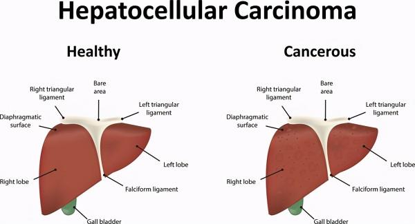 死亡率很高的急性肝衰竭,可由中草藥引起,請慎用 死亡率很高的急性肝衰竭,可由中草藥引起,請慎用