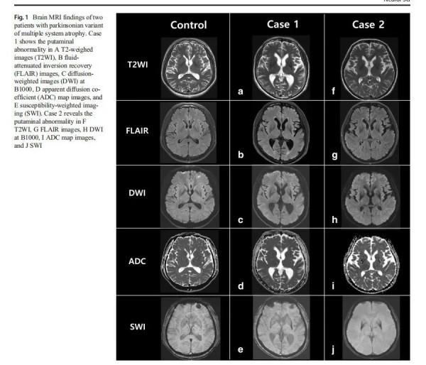多系統萎縮，我是得了帕金森病嗎？