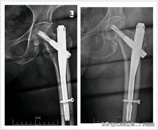 22張高畫質X線片!帶你看清胯骨骨折手術前後對比 22張高畫質X線片!帶你看清胯骨骨折手術前後對比