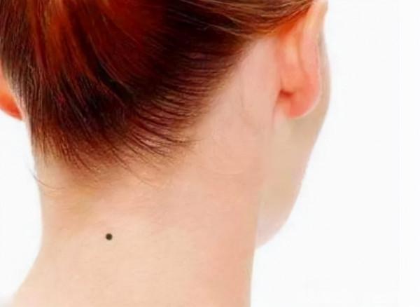 為何有些人脖子後邊都有一顆“痣”？是好是壞？原來並不是巧合