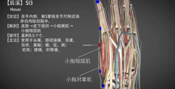 後溪穴—急性扭傷腰痛