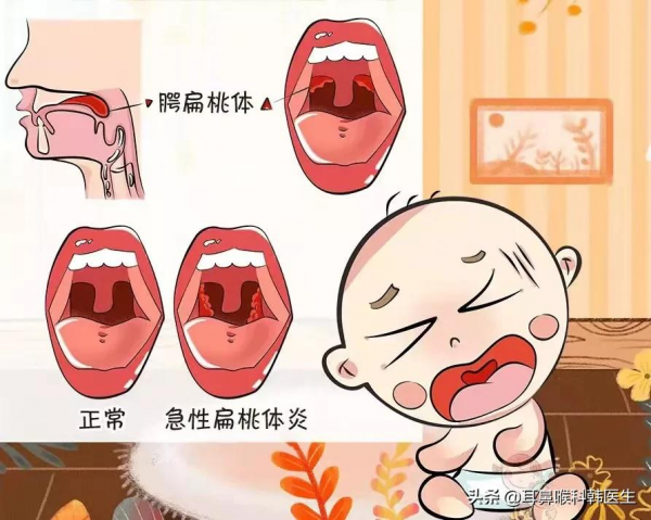 急！扁桃體又發炎了