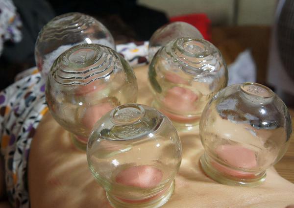 拔火罐時，後背吸出的瘀血，是排出的毒素嗎？聽聽醫生怎麼說