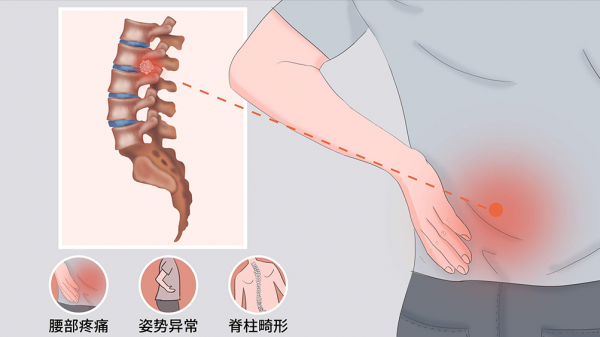 為啥出現腰腿痛,反覆治不好?這3個病因很常見,醫生告訴您真相 為啥出現腰腿痛,反覆治不好?這3個病因很常見,醫生告訴您真相