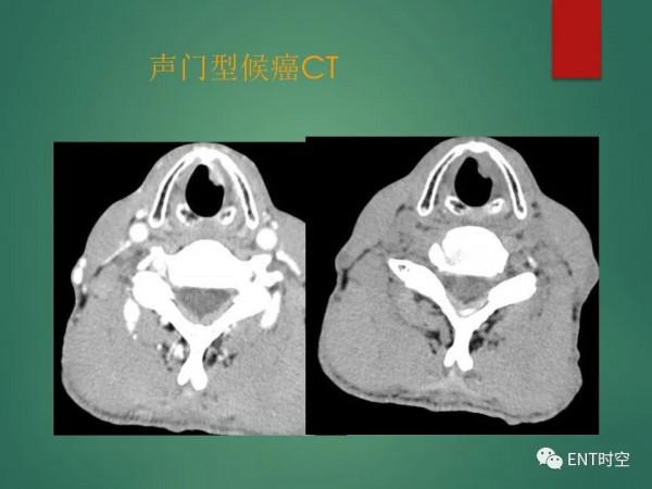 頭頸五官CT斷層解剖圖及常見病影像診斷