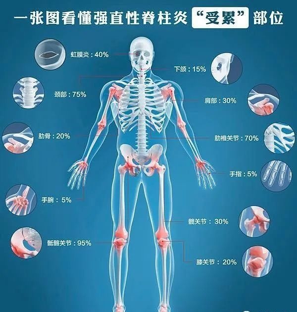 脊柱關節炎、強直性脊柱炎怎麼能分清?一文教你讀懂 脊柱關節炎、強直性脊柱炎怎麼能分清?一文教你讀懂