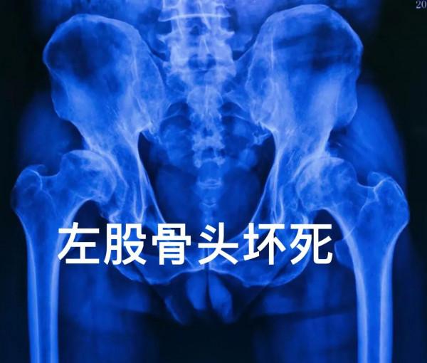 老年股骨頭壞死系列之人工全髖關節置換術&mdash;&mdash;最新微創手術入路