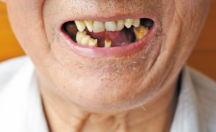 老年人戴假牙，要當心不要踩到這些“坑”