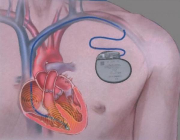 駭客巴納拜:讓ATM吐錢,公開心臟起搏器漏洞前離奇死亡 駭客巴納拜:讓ATM吐錢,公開心臟起搏器漏洞前離奇死亡