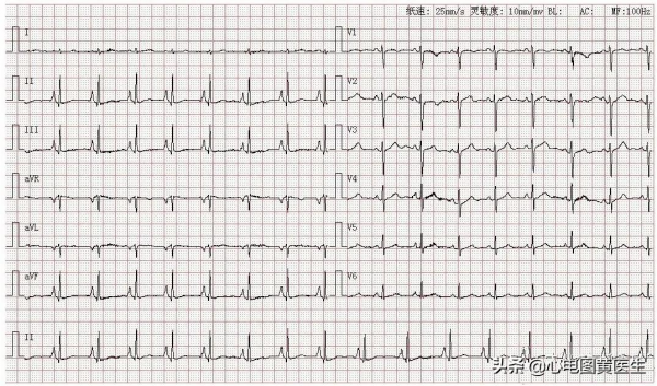 心電圖讀圖練習 心電圖讀圖練習