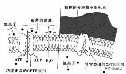 反覆發作鼻竇炎、咳嗽、支氣管擴張,這個病我們要提高認識 反覆發作鼻竇炎、咳嗽、支氣管擴張,這個病我們要提高認識