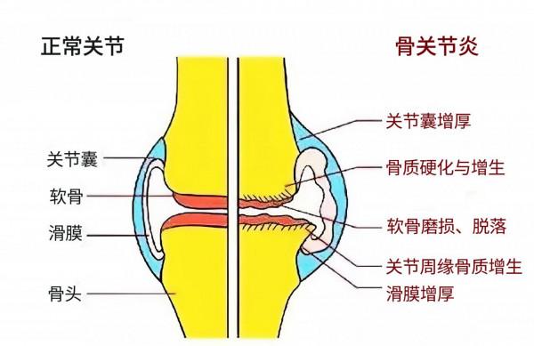 膝關節退變疼痛難忍,吃點對乙醯氨基酚就行了,不用看醫生? 膝關節退變疼痛難忍,吃點對乙醯氨基酚就行了,不用看醫生?