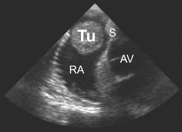 你知道心臟為什麼不容易得癌症嗎? 你知道心臟為什麼不容易得癌症嗎?