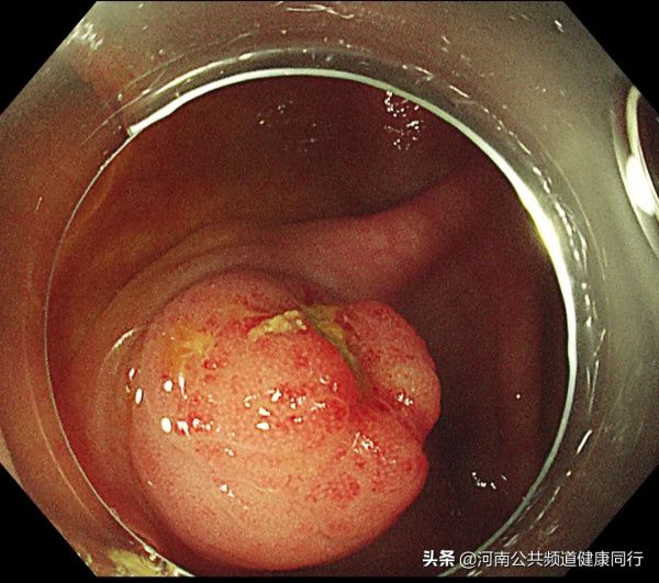 “偽裝的糞石”——在鄭大一附院進行的一例特殊的盲腸隆起型病變內鏡下治療