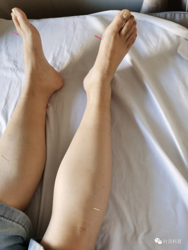 脈診針灸治療咳嗽案例一則 脈診針灸治療咳嗽案例一則