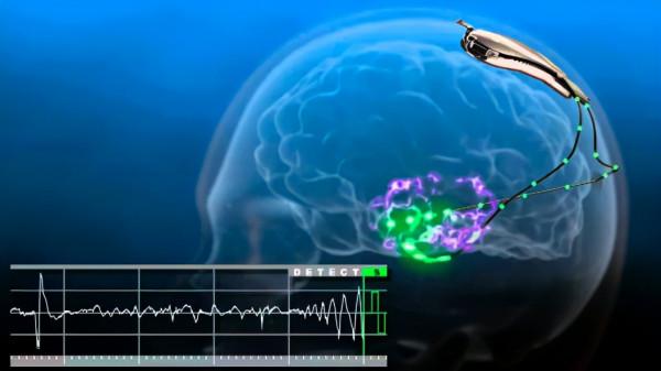 用晶片扼殺食慾，從源頭解決肥胖問題