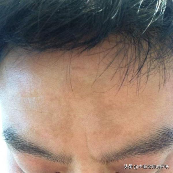 色斑也得分類別，從中醫角度淺談色斑成因，這樣治療更有效