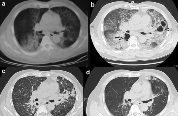 女子胸痛、咳嗽,主診醫師考慮肺癌準備手術,主任會診後:誤診了 女子胸痛、咳嗽,主診醫師考慮肺癌準備手術,主任會診後:誤診了