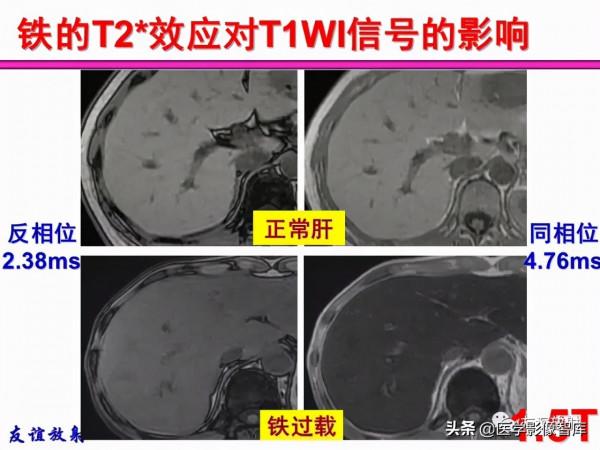 臨床MRI訊號分析基礎：常規序列及DWI序列