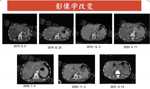 有效抑制癌症復發轉移，新案例證明：細胞免疫治療這點強