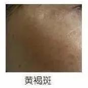 祛斑攻略——常見色斑形成原因和護理方法 祛斑攻略——常見色斑形成原因和護理方法