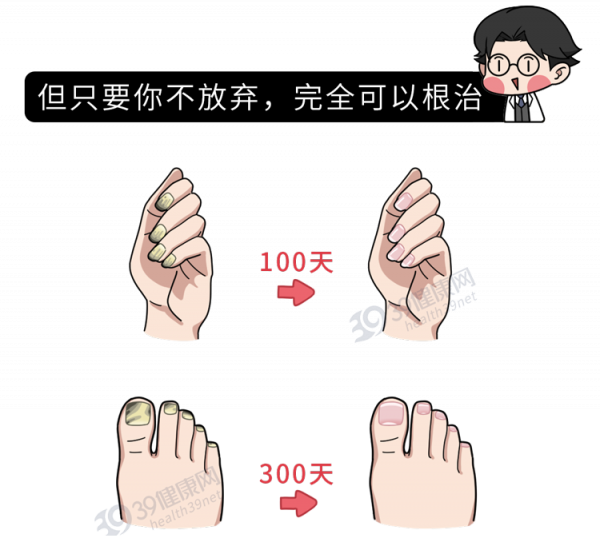 得了灰指甲,反覆發作難根治?一次性介紹7種藥,總有一款適合你 得了灰指甲,反覆發作難根治?一次性介紹7種藥,總有一款適合你