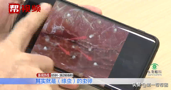 喜食切片生肉，二十歲小夥突發癲癇險致命！元兇竟是一種蟲