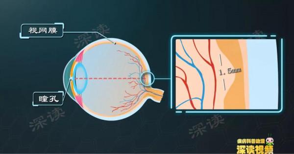 年紀大了黃斑會變性？不痛不癢就瞎了？動漫解析“老黃”致盲細節