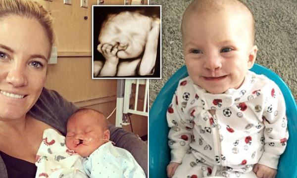 父母不顧醫生建議拒絕墮胎，重度唇顎裂的寶寶現在長成美男了