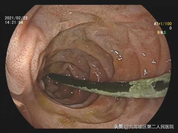 男子生吞15cm鐵絲,6天后腹部不適就診,原來鐵絲進了十二指腸 男子生吞15cm鐵絲,6天后腹部不適就診,原來鐵絲進了十二指腸