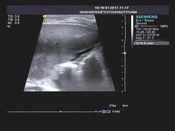 淺析幼兒黃疸之膽道閉鎖的超聲表現