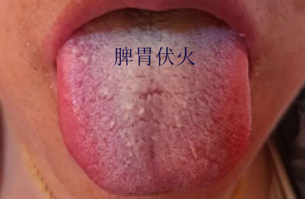 舌頭有裂紋就是陰虛嗎?教你形象地認識四種裂紋舌,十種舌象 舌頭有裂紋就是陰虛嗎?教你形象地認識四種裂紋舌,十種舌象