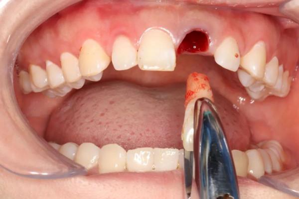 同仁醫線丨精準種植，美學修復，再也不用愁眉苦臉了